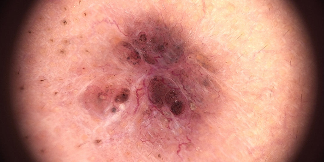 El carcinoma es un tipo de cáncer que se origina en las células epiteliales, que son las células que recubren la piel, órganos internos y glándulas. 