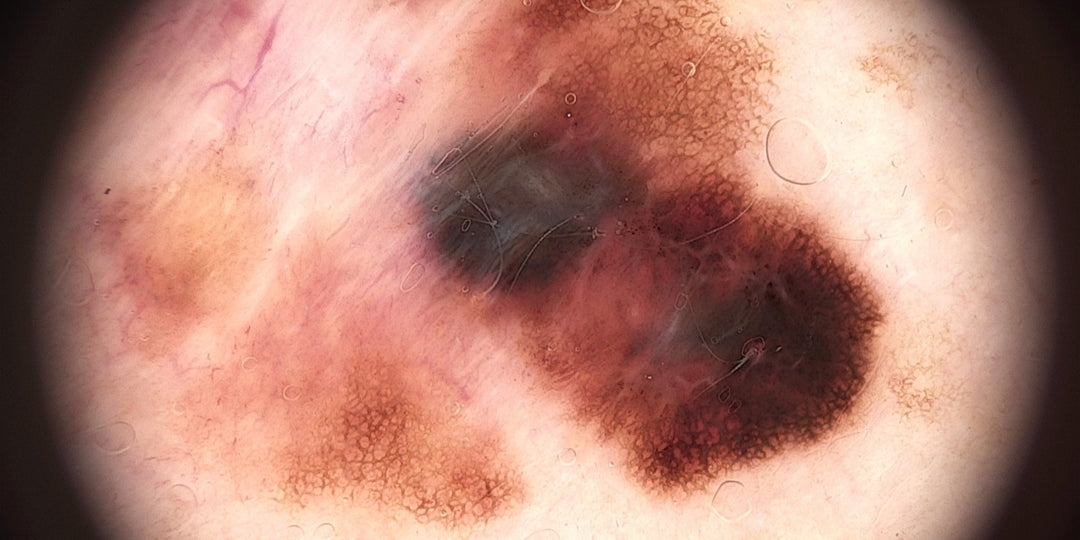 Melanoma: Todo lo que debes saber sobre este cáncer de piel