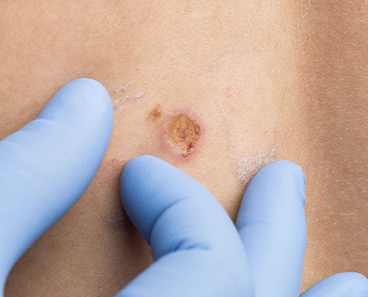 Si tienes un tumor maligno en la piel, necesitas cirugía para eliminar las células cancerígenas y también desearías preservar lo mejor posible de la estética todo en un solo procedimiento, entonces la consulta de Cirugía de Mohs es lo adecuado.