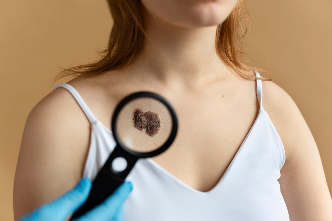 La consulta de Cirugía Oncológica por melanoma maligno es atendida por el especialista Cirujano Oncólogo el cual brindará información como opción de tratamiento principal la cirugía para erradicar el melanoma maligno generalmente en etapa inicial.