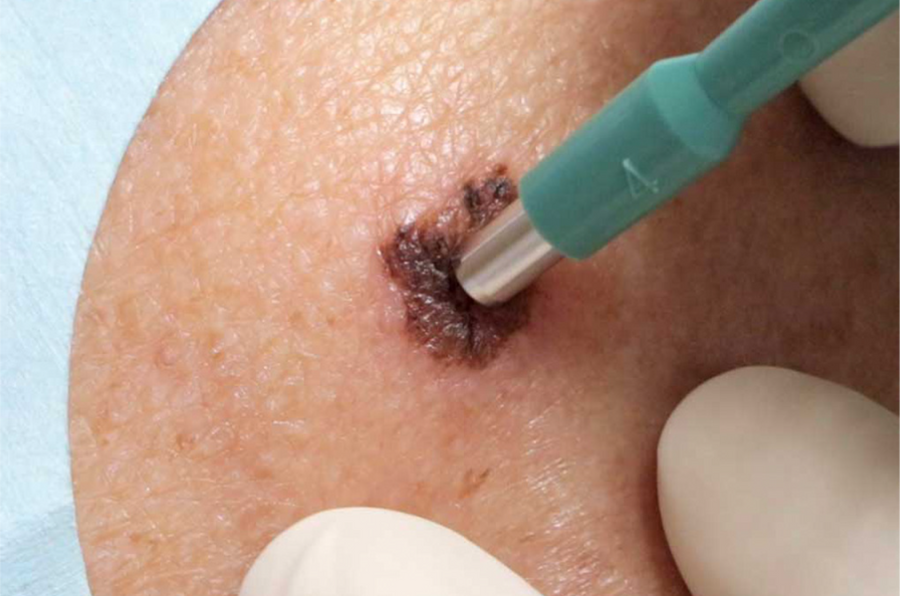 La consulta de Biopsia Punch es realizada por el especialista de Cirugía Oncológica, el cual podrá evaluar la sospecha de la piel si se tuviera una mancha, lunar o lesión preocupante.