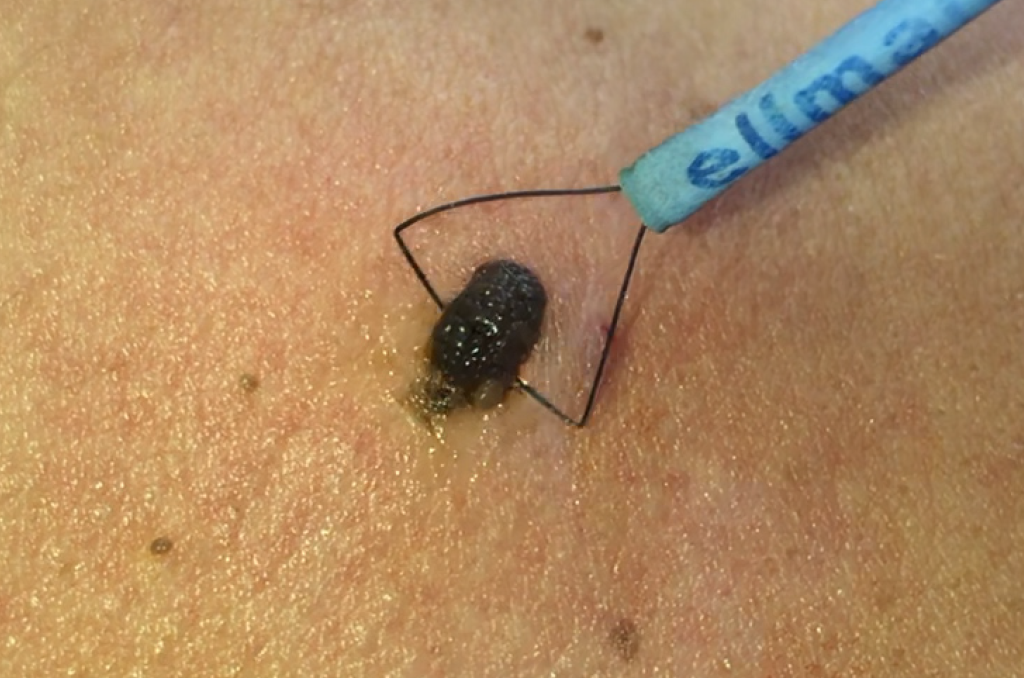 Si tienes lesiones en la piel como verrugas, lunares de carne, acrocordones o angiomas cutáneos que deseas retirarlos la consulta de Radiocirugía para retiro de lunares es la adecuada