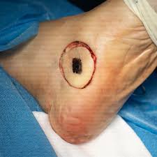 Si te han diagnosticado un tumor maligno en la piel y te han sugerido una cirugía la consulta de Resección local amplia es ideal para tu caso, el procedimiento es una cirugía oncológica que se realiza para una variedad de tumores cutáneos.